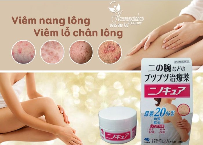 Kem trị viêm nang lông Kobayashi Nhật Bản được bóp ra từ tuýp, sẵn sàng cho việc thoa lên vùng da bị tổn thương
