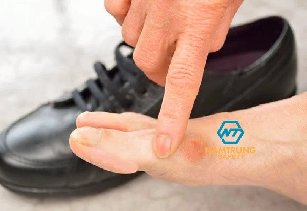 Ảnh minh họa bàn chân bị đau nhức do mang giày bị chật 1 size