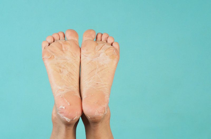 Da chân khô và bong tróc nhẹ ở ngón chân, có thể do thiếu ẩm hoặc đi giày thường xuyên