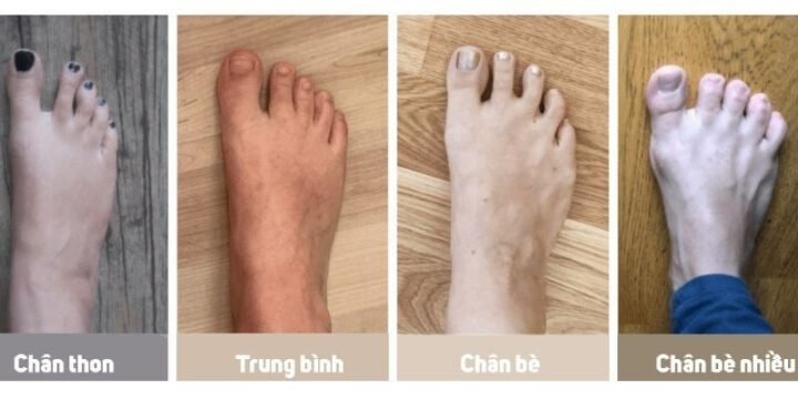 Hình ảnh mô tả đặc điểm bàn chân bè với chiều ngang lớn hơn bình thường, giúp người đọc dễ dàng nhận diện size giày cho chân bè.