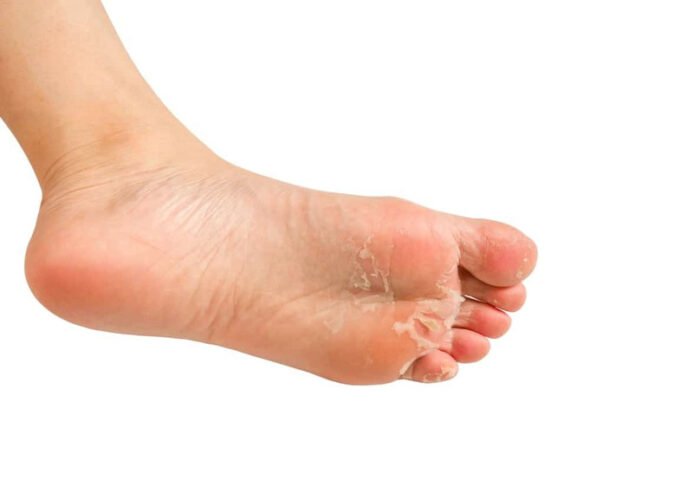 Lòng bàn chân bị bong da thành từng mảng lớn, biểu hiện của việc đi giày nhiều bị bong da chân