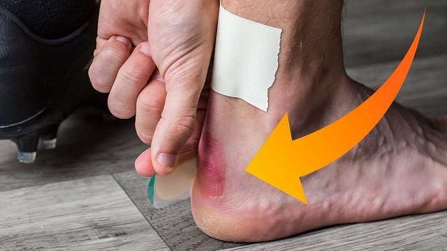 Nguy cơ tổn thương và phồng rộp da chân khi mang giày mà không mang vớ.