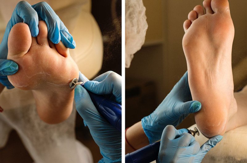 Thoa kem dưỡng ẩm để chăm sóc da chân khô, nứt nẻ, giúp ngăn ngừa bong tróc khi đi giày